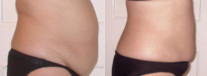 women-abdomen-before-after.jpg